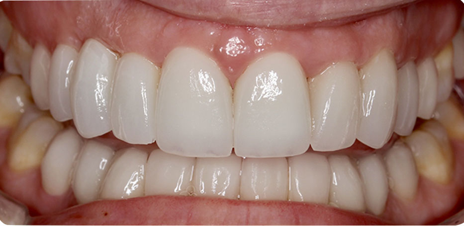  dental veneers Phuket, best dentist in Phuket, dentist Phuket, veneers Phuket