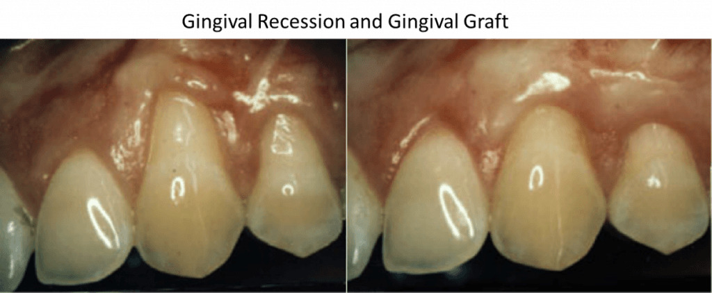 Gingival recession and Gingival Graft 2