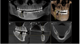 Dental CT Scan