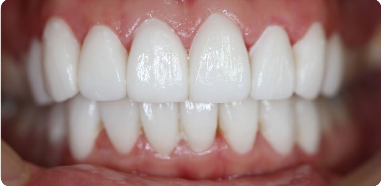 Before and After Photos Dentist Phuket | NewSmileDentists