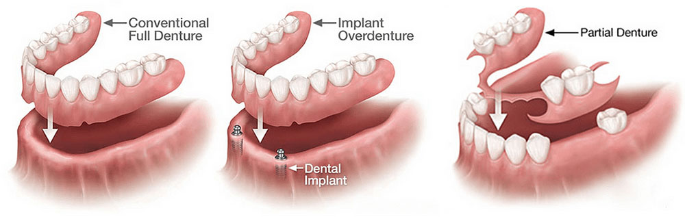 Dentures