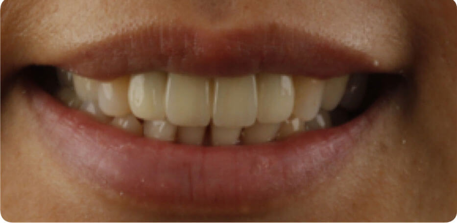  dental veneers Phuket, best dentist in Phuket, dentist Phuket, veneers Phuket