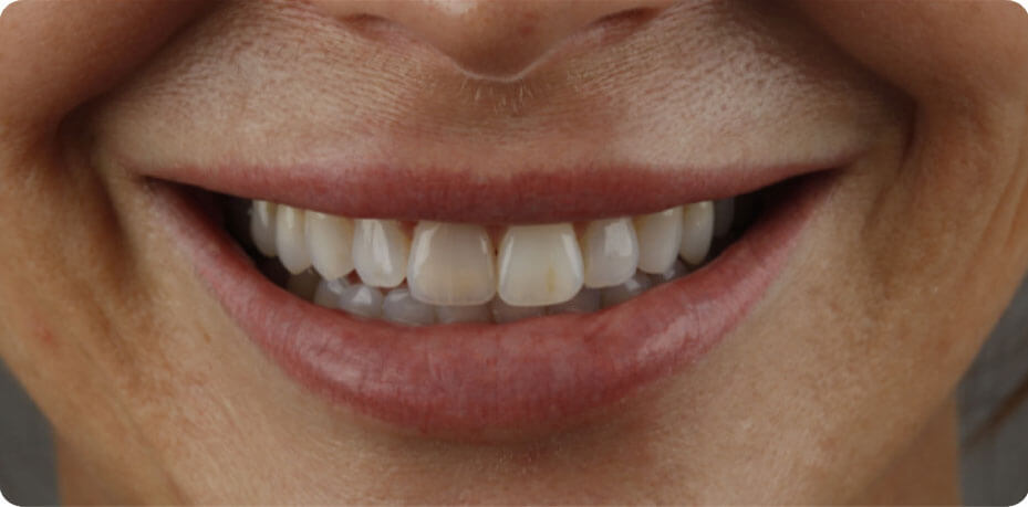  dental veneers Phuket, best dentist in Phuket, dentist Phuket, veneers Phuket