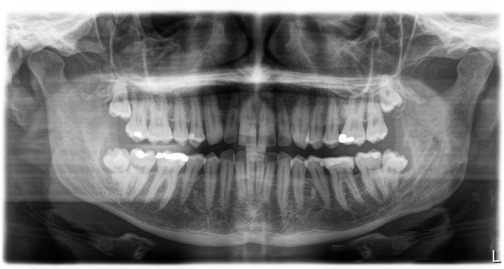 Dental x-ray