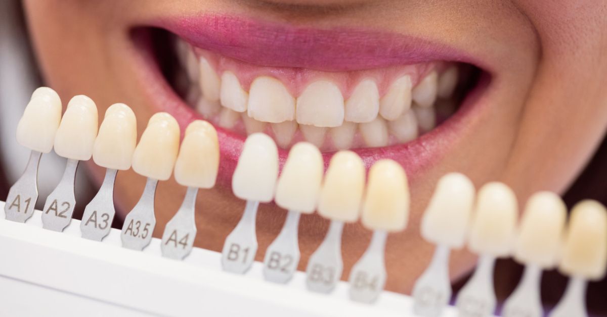 Why Are My Teeth Yellow? Understanding Causes and Treatments